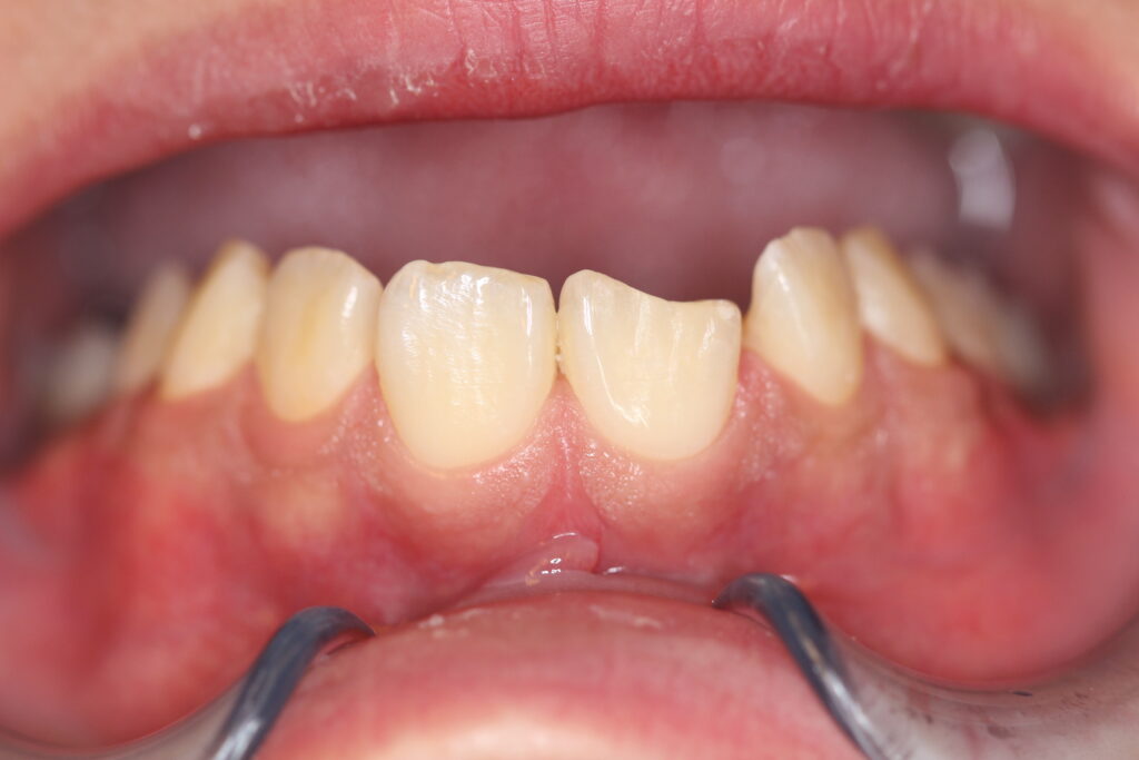 Non-prep Veneers-Initial