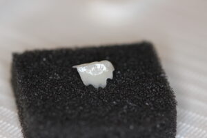 Non-prep Veneers