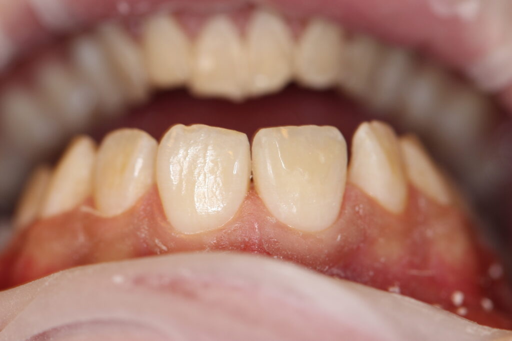 Non-prep Veneers-Final