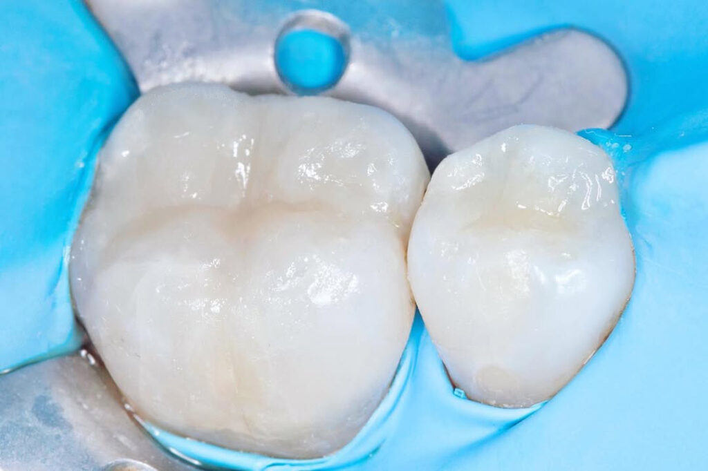 Amalgam – und Metallsanierung