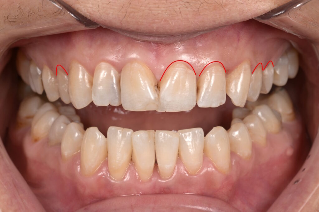 Zahnfleischkorrektur- before