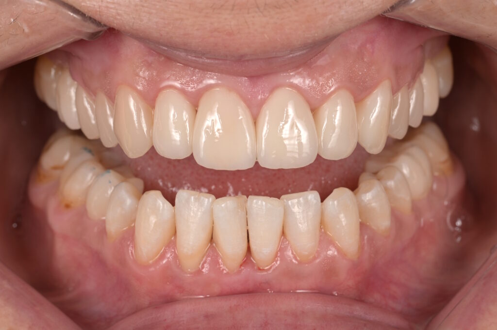 Zahnfleischkorrektur - after