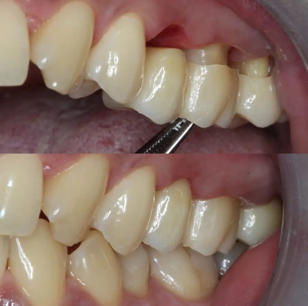Keramische Kronen & Brücken