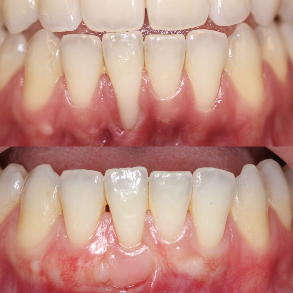 Zahnfleischtransplantation