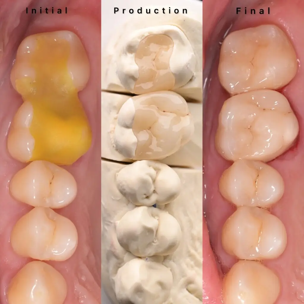 Keramikfüllung / Inlays